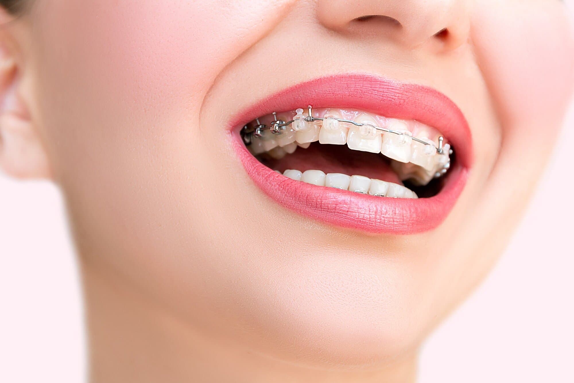 Auxiliaire & Attachement orthodontiques