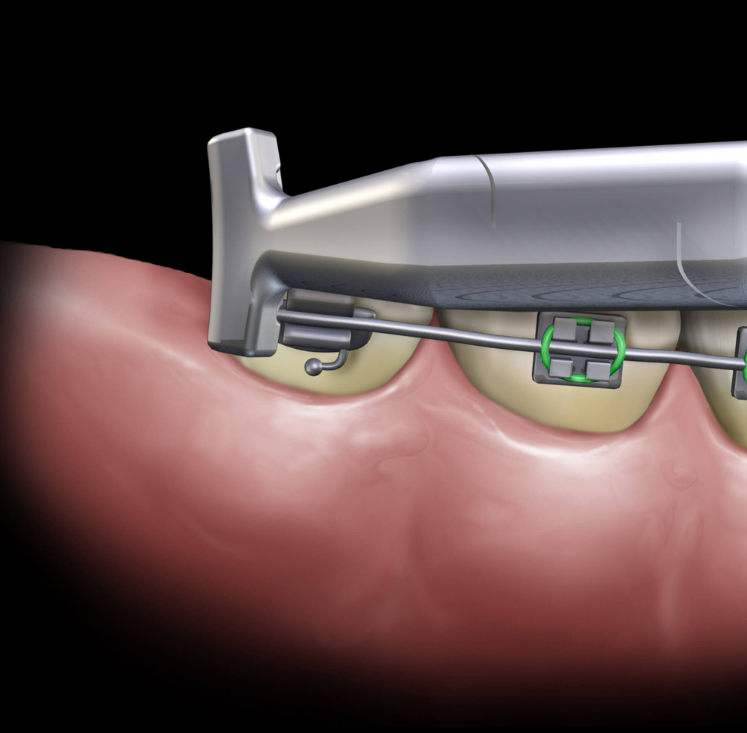 Pince à plier le fil NiTi HAMMERHEAD - HU FRIEDY